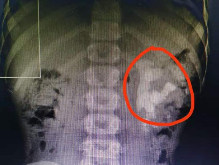 输尿管结石吃七种食物最好,输尿管结石禁吃食物