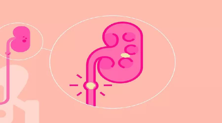 男孩尿液混浊的原因,吃鱼后尿液混浊是什么原因