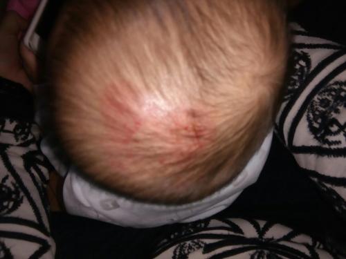 孩子摔到头血肿嗜睡,小孩摔倒头皮血肿严重吗