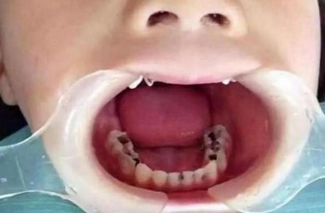 三岁孩子大牙是虫牙怎么办,3岁孩子满口都是黑牙