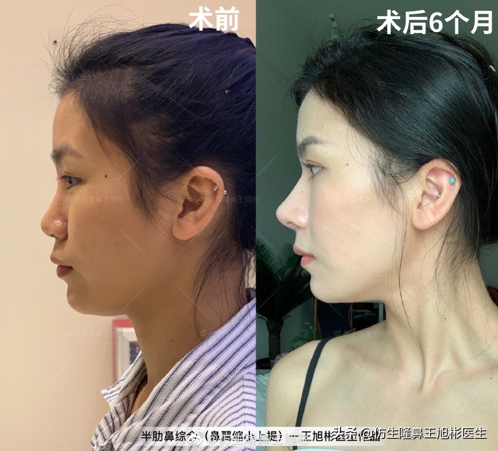 那些被鼻子“封印”颜值的鼻综合/修复案例|广州鼻整形