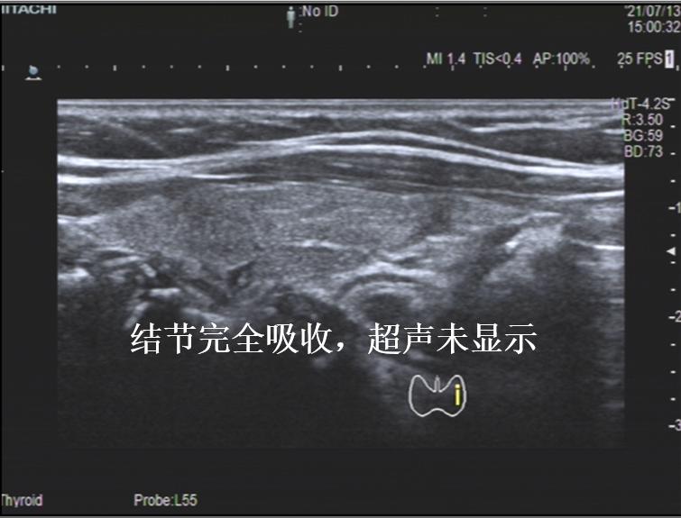 哈尔滨微创消融甲状腺结节哪家好,甲状腺结节微创消融术的过程
