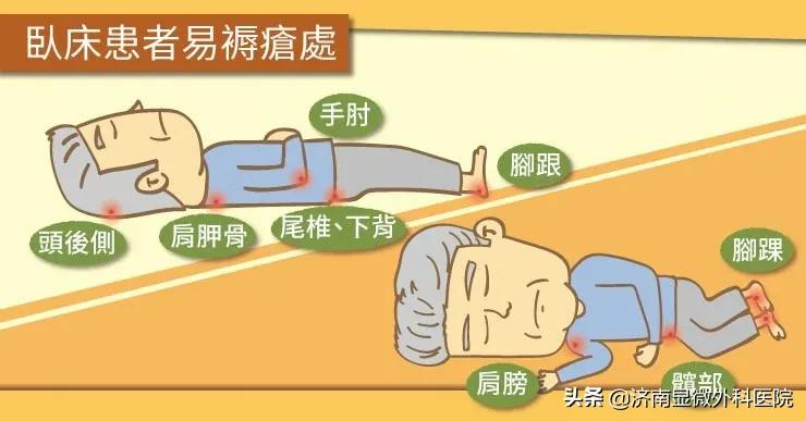 褥疮的预防和护理正确做法,得了压疮正确的护理方式