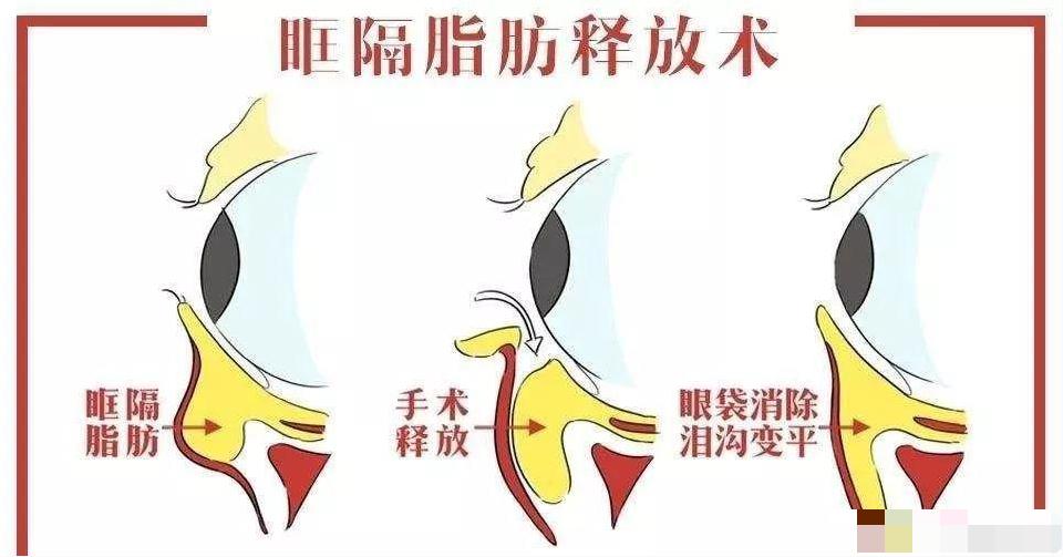 双眼皮眼袋术后真实案例,眼袋手术前视频