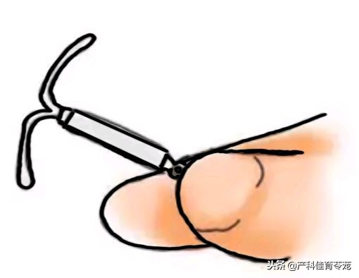 肌瘤和腺肌瘤的关系,肌瘤与腺肌瘤的区别