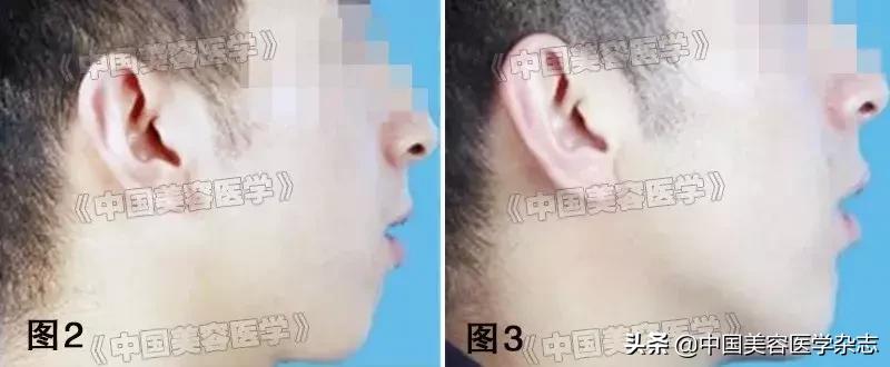 纳米脂肪填充和prp有啥区别,脂肪填充和prp