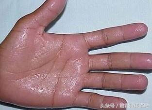 小孩自汗盗汗中医药方,张景明自汗盗汗中医辨证论治