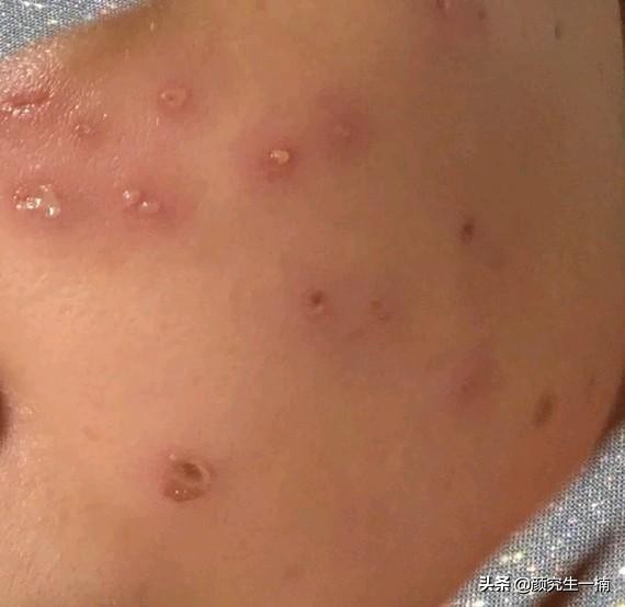 祛痣恢复全过程图片,帅哥祛痣完美蜕变