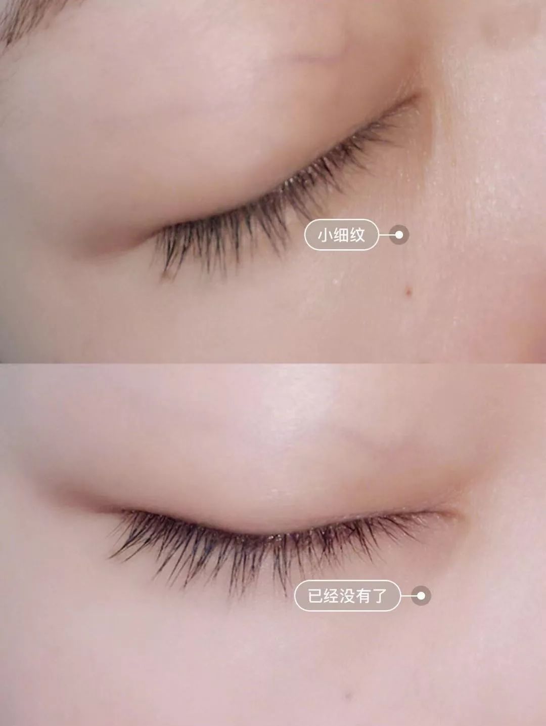 关晓彤有没有黑眼圈,关晓彤黑眼圈困扰