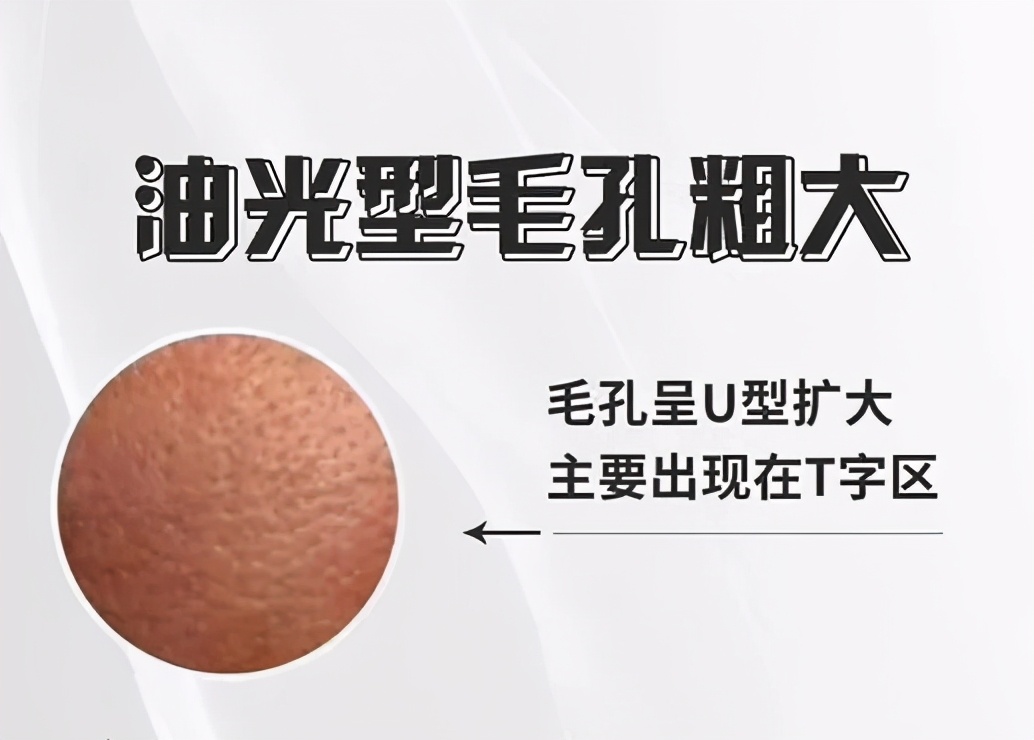 夏季毛孔清爽一夏,夏日毛孔粗大怎么拯救