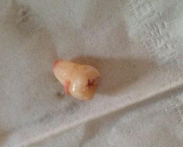 为什么智齿上面的牙龈很臭,为啥智齿臭