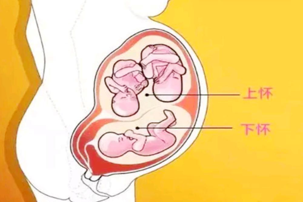 孕妈上怀和下怀产后哪个好恢复,孕妇怀孕初期上怀和下怀的区别
