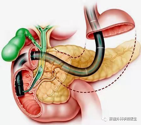 胆囊切除30天就疼,胆囊结石切除后半年疼痛什么原因