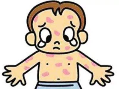 头孢克肟过敏皮疹会自己消吗,吃头孢会起疹子么