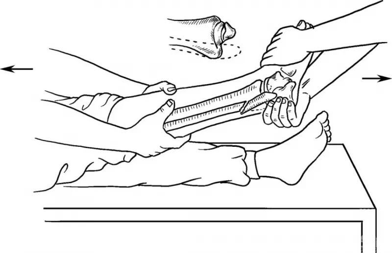 骨折闭合复位髓内钉内固定术,骨折闭合复位