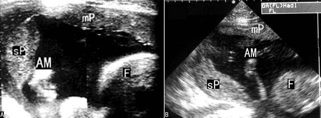 前置胎盘的超声表现及鉴别诊断,胎盘超声显像检查