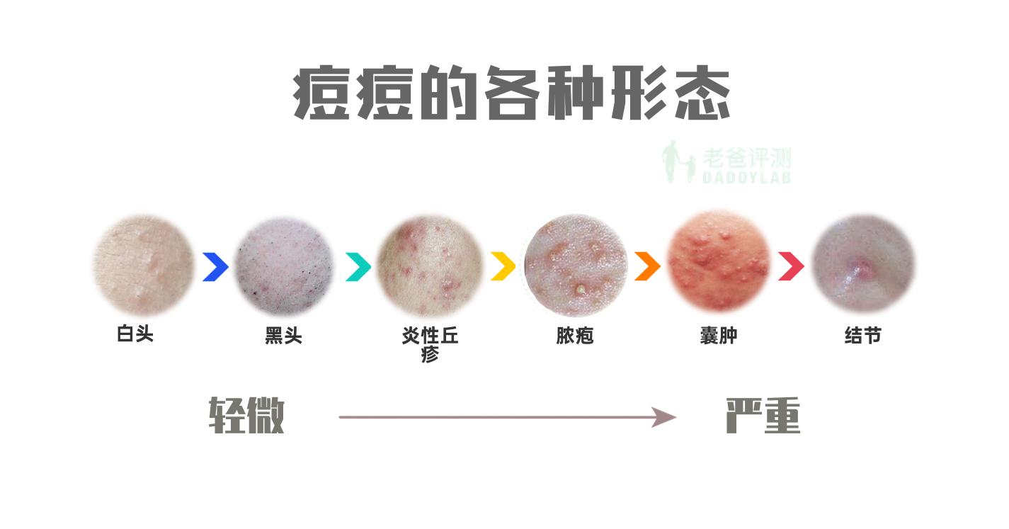烦人的痘痘怎么来的,痘痘反复真烦人分清类型对症下药