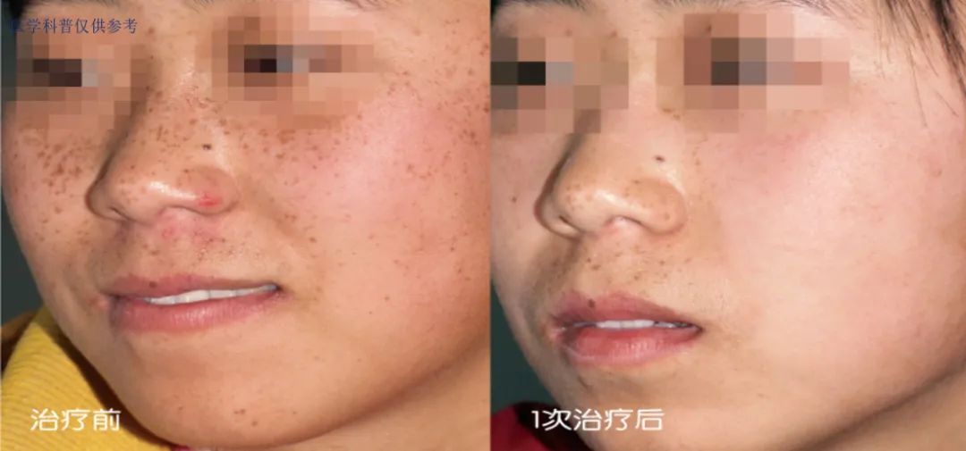 明星都在做的医美,光电光子嫩肤