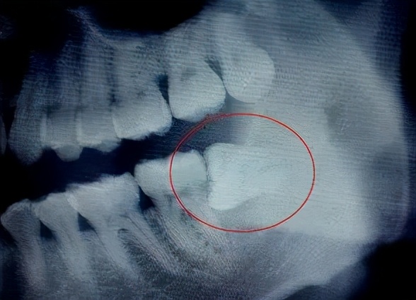 我的牙为什么越来越黄,我的牙长歪了该怎么办