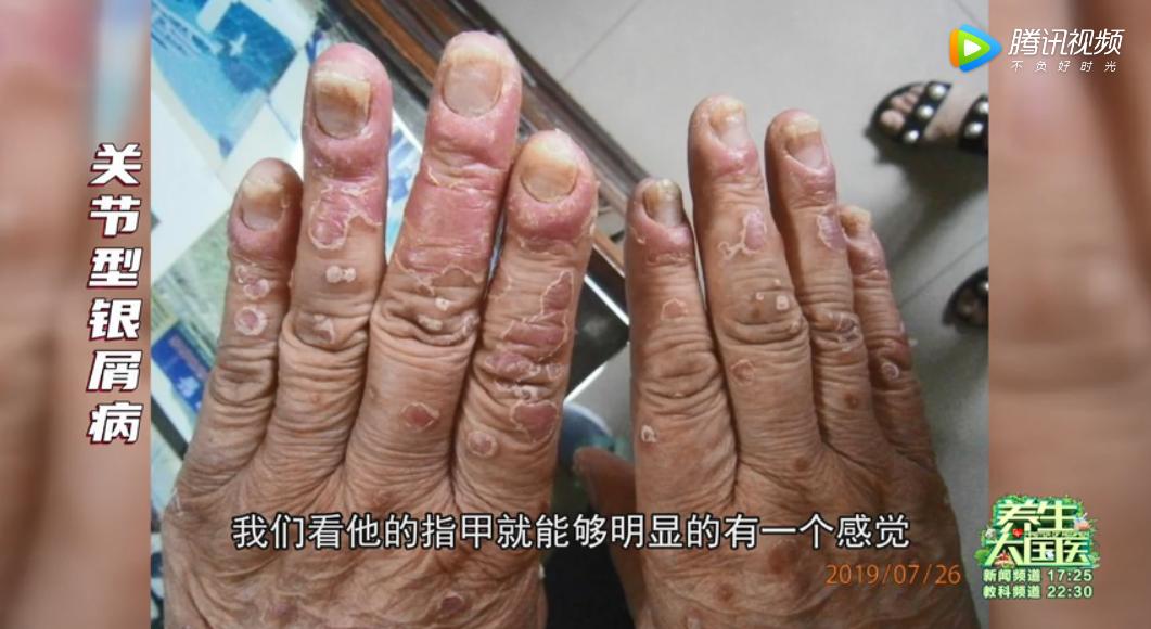 头皮发痒与体内疾病有关,头皮舌头发麻发木是什么病的前兆