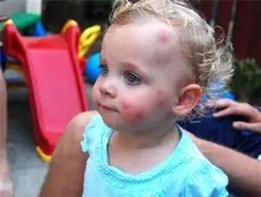 婴幼儿防蚊攻略,婴幼儿防蚊最有效的方法