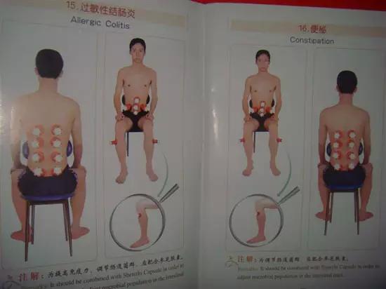 拔罐有哪些穴位图解,最全拔罐穴位疗法图解