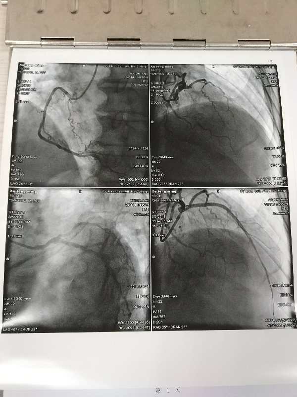 起床后胸闷气短背痛,突然胸闷背痛出汗