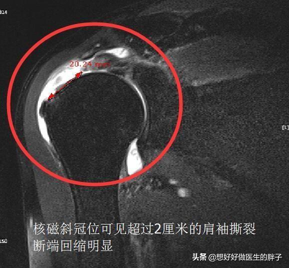 左肩疼痛是什么病的预兆,左肩疼痛要警惕什么病