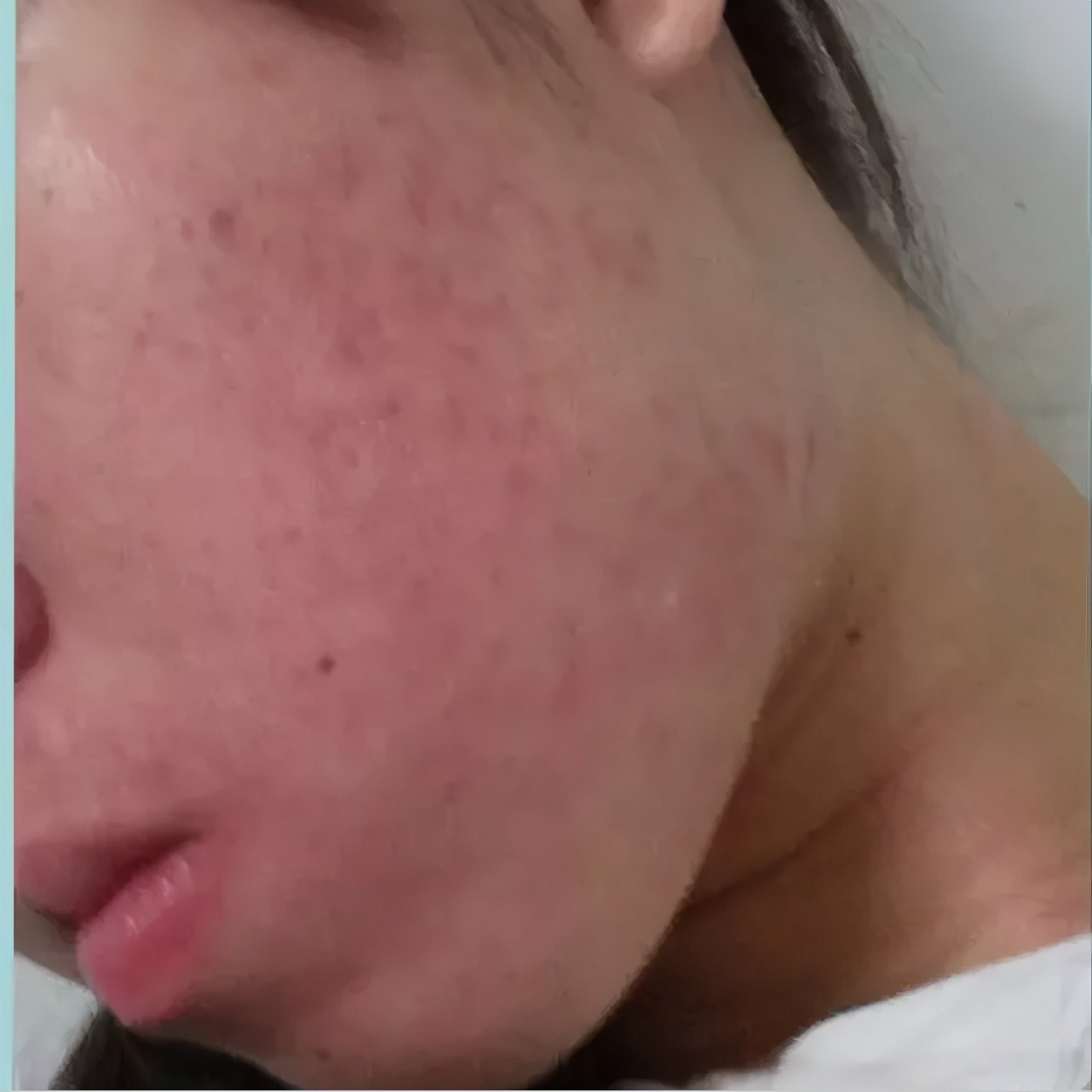 治痘痘维a酸类药膏哪个好,异维a酸胶囊可以永久治好痘痘吗