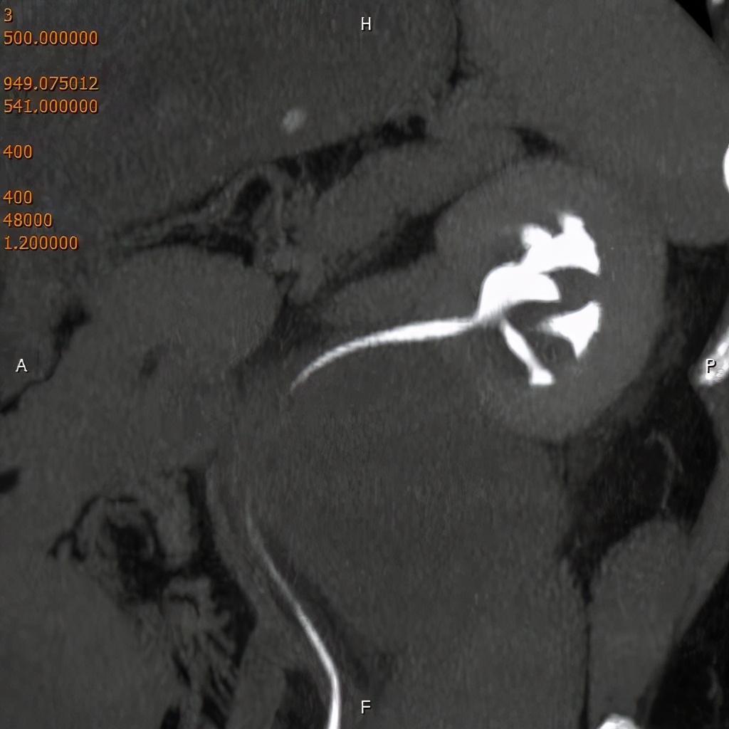 尿路造影输尿管间断显影,静脉尿路造影和排泄性尿路造影