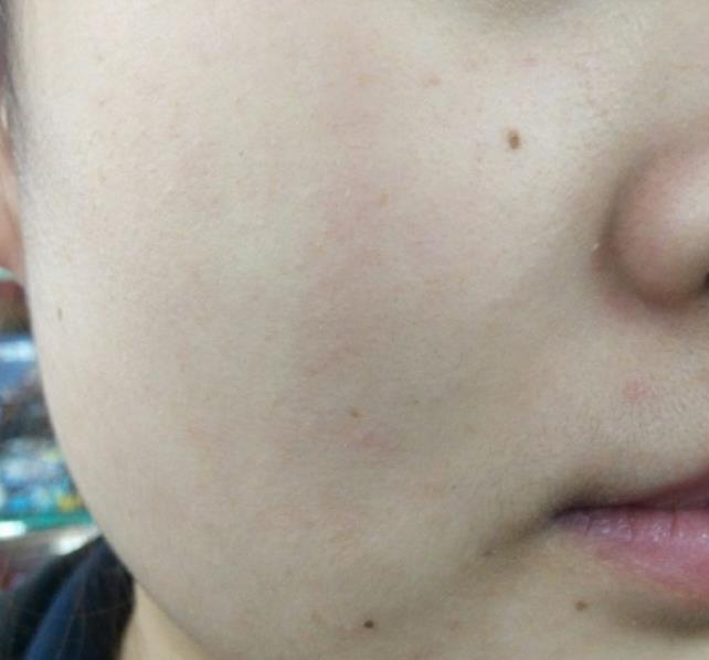 角质层薄红血丝皮肤怎么护理,角质层薄发红怎么护理