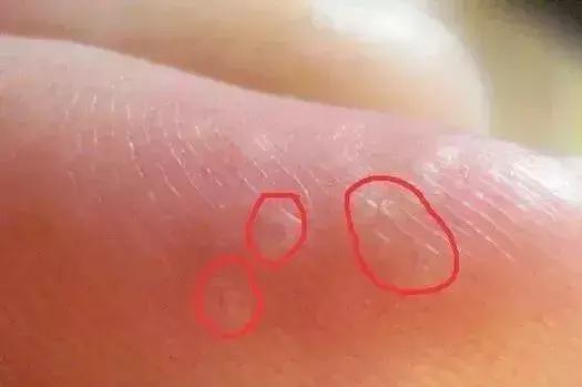 天热手上起水泡怎么回事,天气一热手上就长小水泡怎么回事