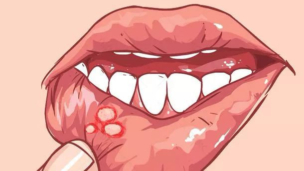 频繁的口腔溃疡是口腔癌的前兆吗,口腔溃疡数周未愈警惕口腔癌