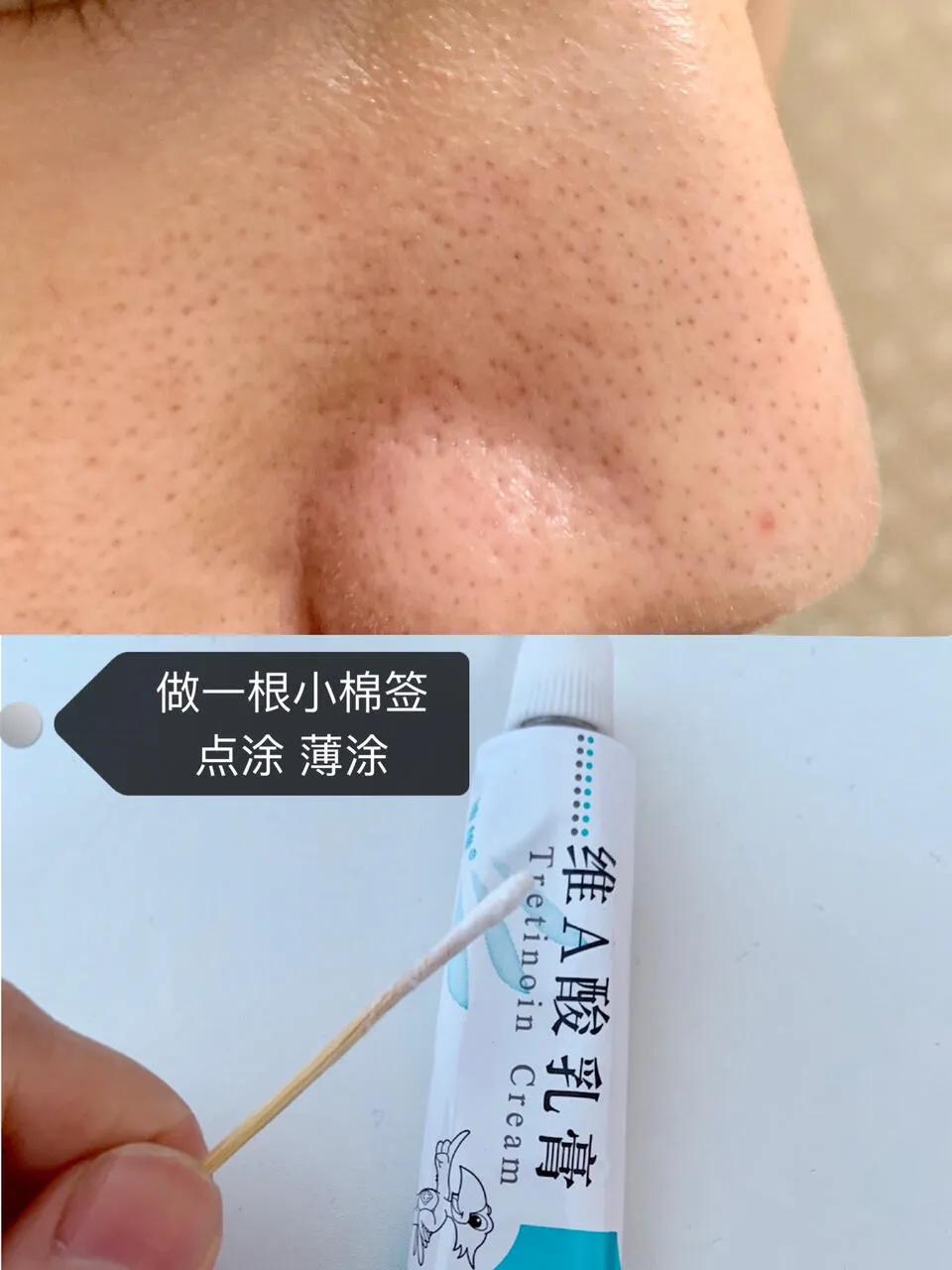 好用的去除黑头小妙招,去除黑头小窍门一招解决