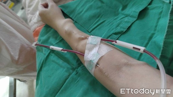 【移植漫长路】她抗拒洗肾曾拜密医　日吞90颗药险死