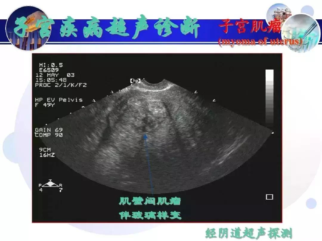 纯干货！子宫及附件解剖和超声诊断