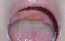 舌苔脉象与病症的关系的对应表,舌苔和病情