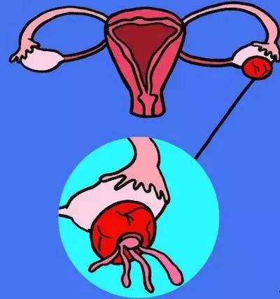 卵巢囊肿21mmx16mm有什么症状,卵巢囊肿的四种症状怎么得的