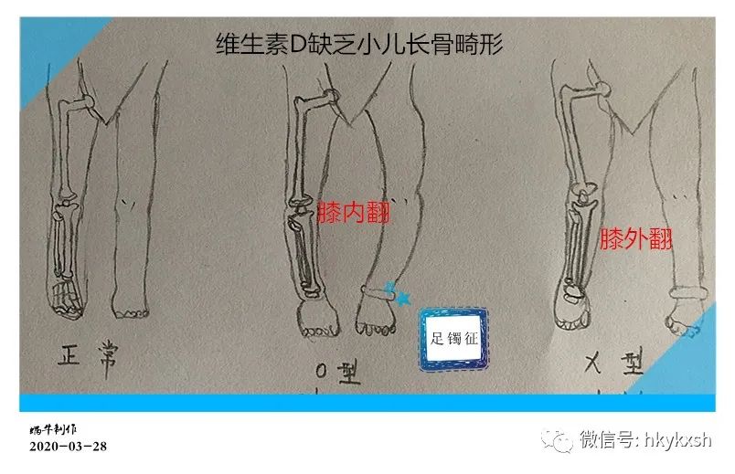 维生素d缺乏性佝偻病试题及答案,维生素d缺乏性佝偻病儿科护理学