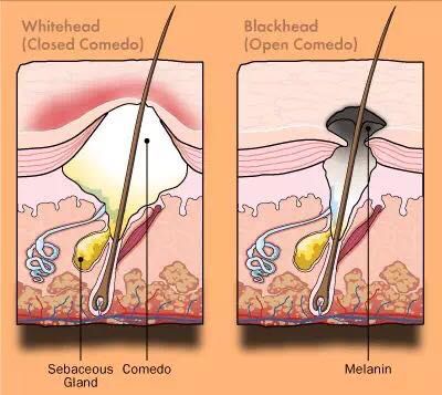 青春期额头闭口粉刺怎样去除,嘴角周围闭口粉刺怎么彻底去除