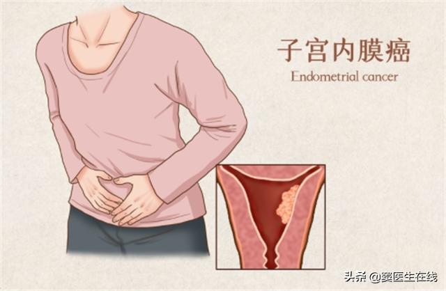 绝经太晚容易得子宫内膜癌吗,绝经越晚是不是寿命越长