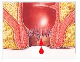 痔疮肛裂肛瘘怎么治疗,痔疮内痔外痔肛裂肛瘘怎么治疗