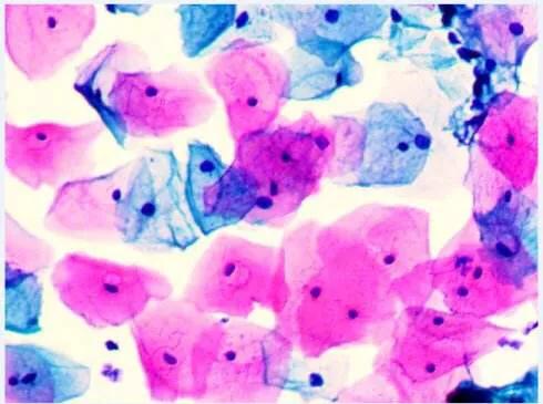 一招预防宫颈癌，TCT了解一下