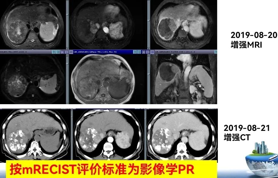 肝癌晚期靶向治疗怎么做,中国肝癌tace治疗展望