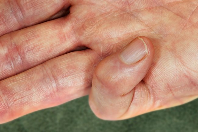 手指肿胀要警惕三种病,手指肿胀是10种疾病的警示信号