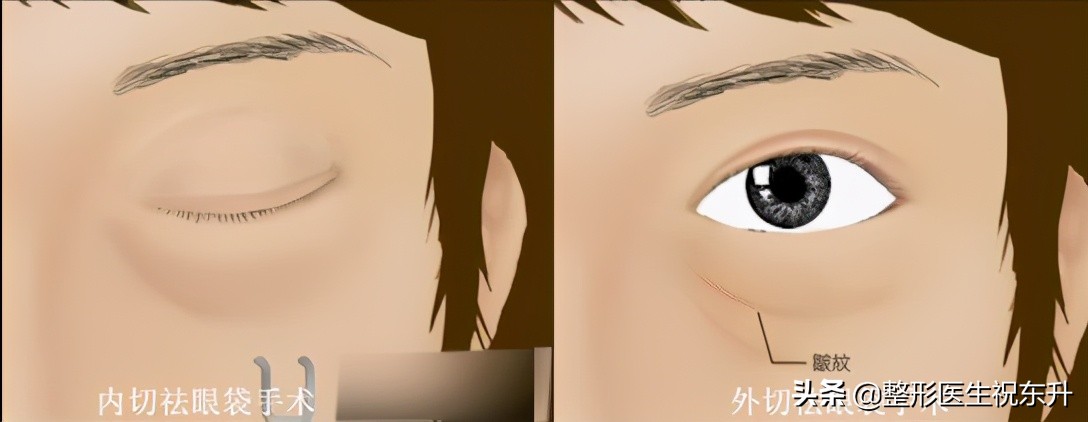 祛眼袋手术的说说,专家解答眼袋手术