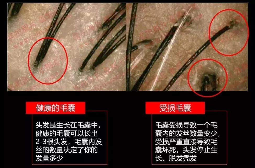 “十男八秃”的日本男人疯抢这瓶小黑钻!让头发不再掉了