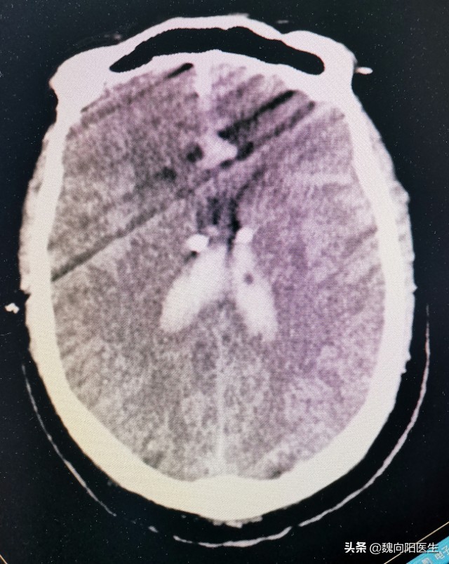 脑出血后积水能好吗,脑出血止住了脑水肿严重吗