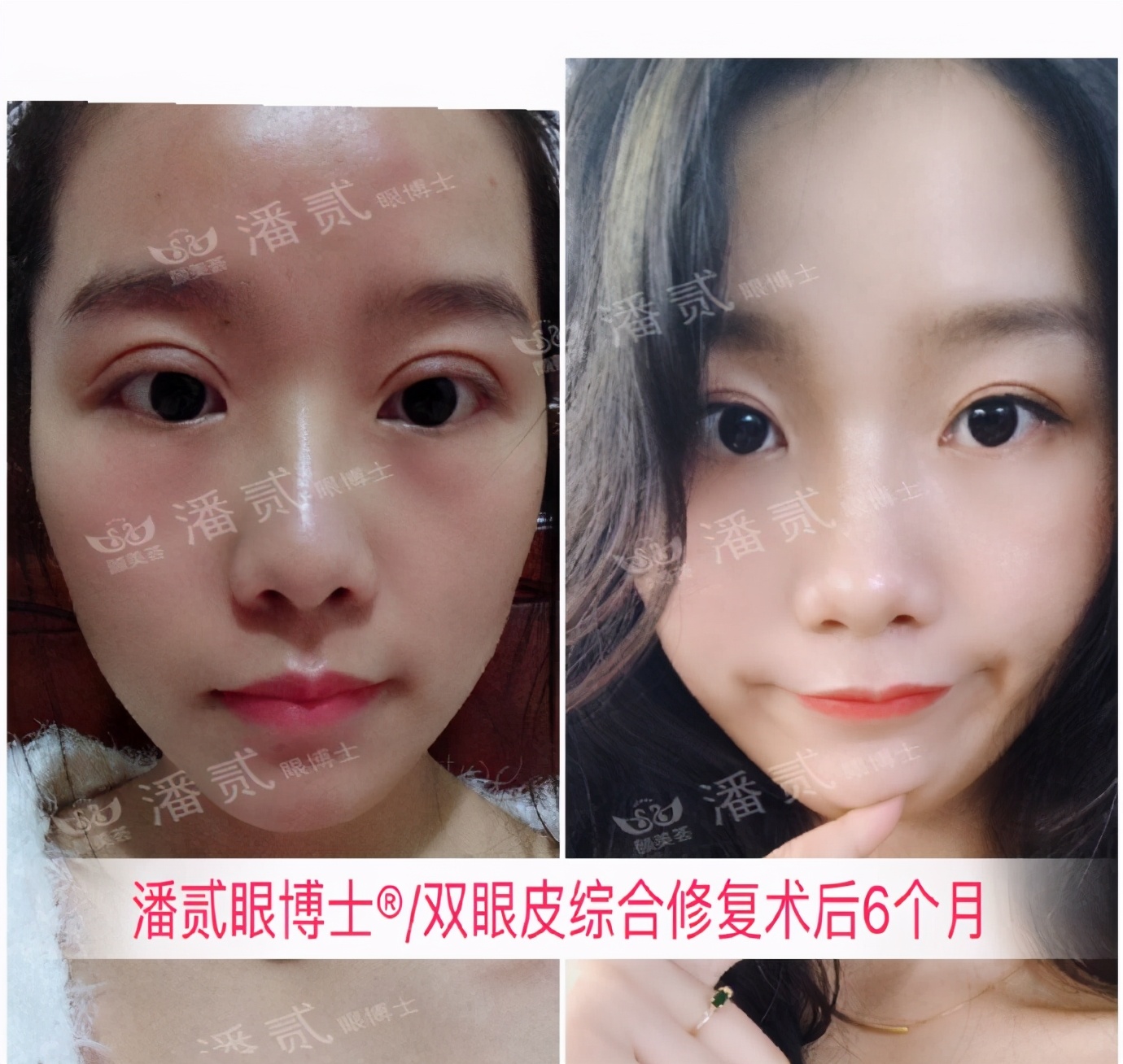 双眼皮整容失败眼皮跳动,双眼皮整形失败修复还花钱吗