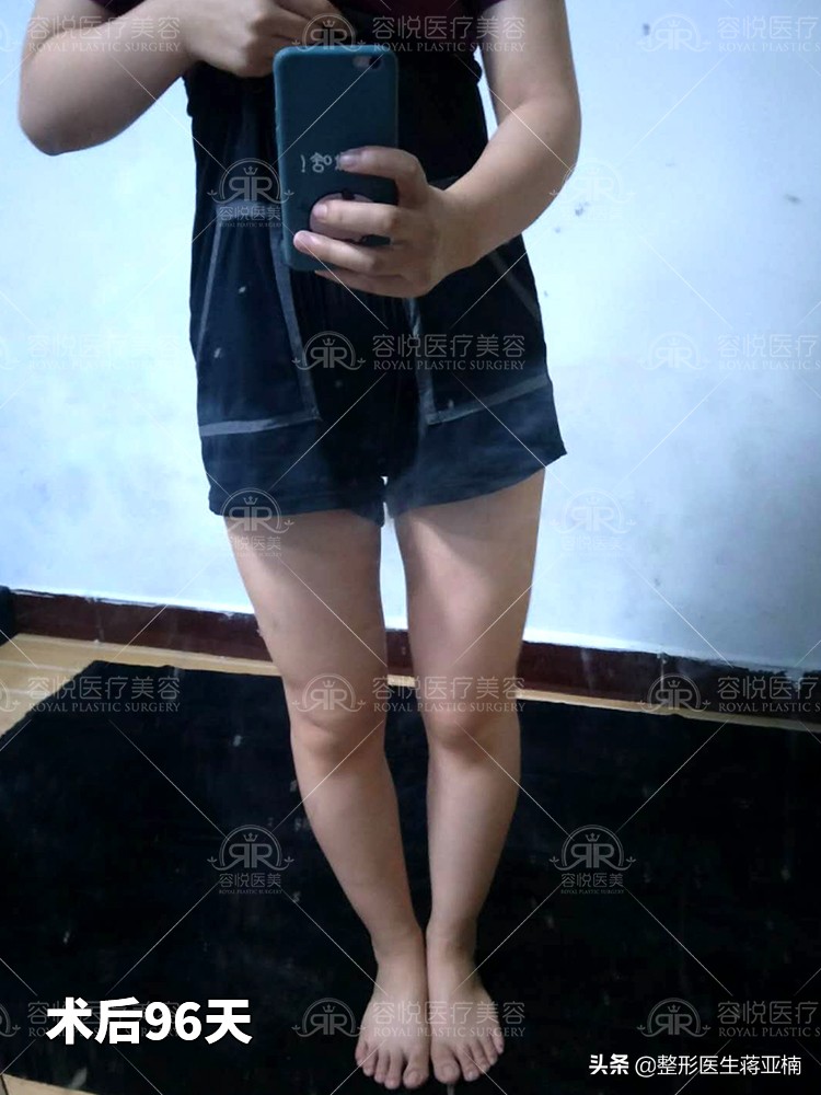 大腿吸脂后变胖,大腿吸脂拯救我的大粗腿